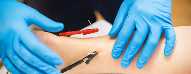 What Is Dry Needling treatment