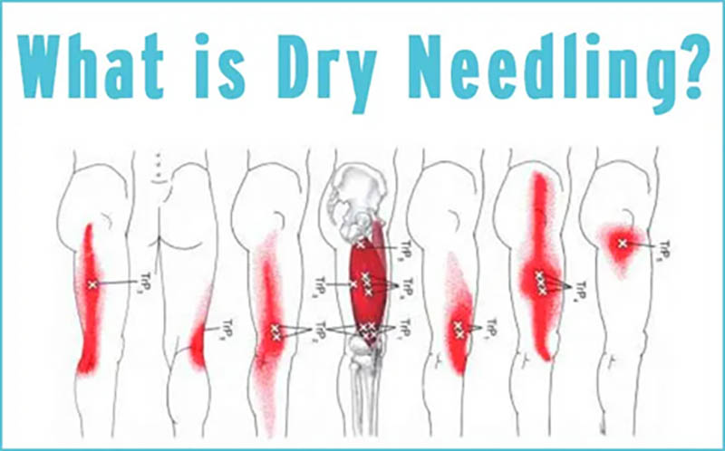 Dry Needling