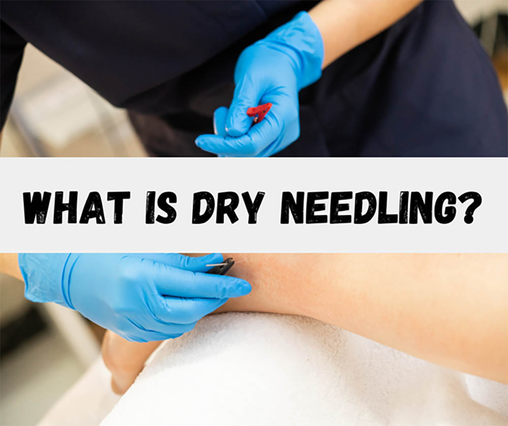 What Is Dry Needling?