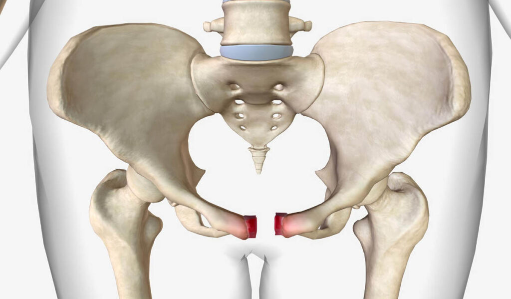 Pelvic Fracture Types: Causes, Symptoms & Treatments