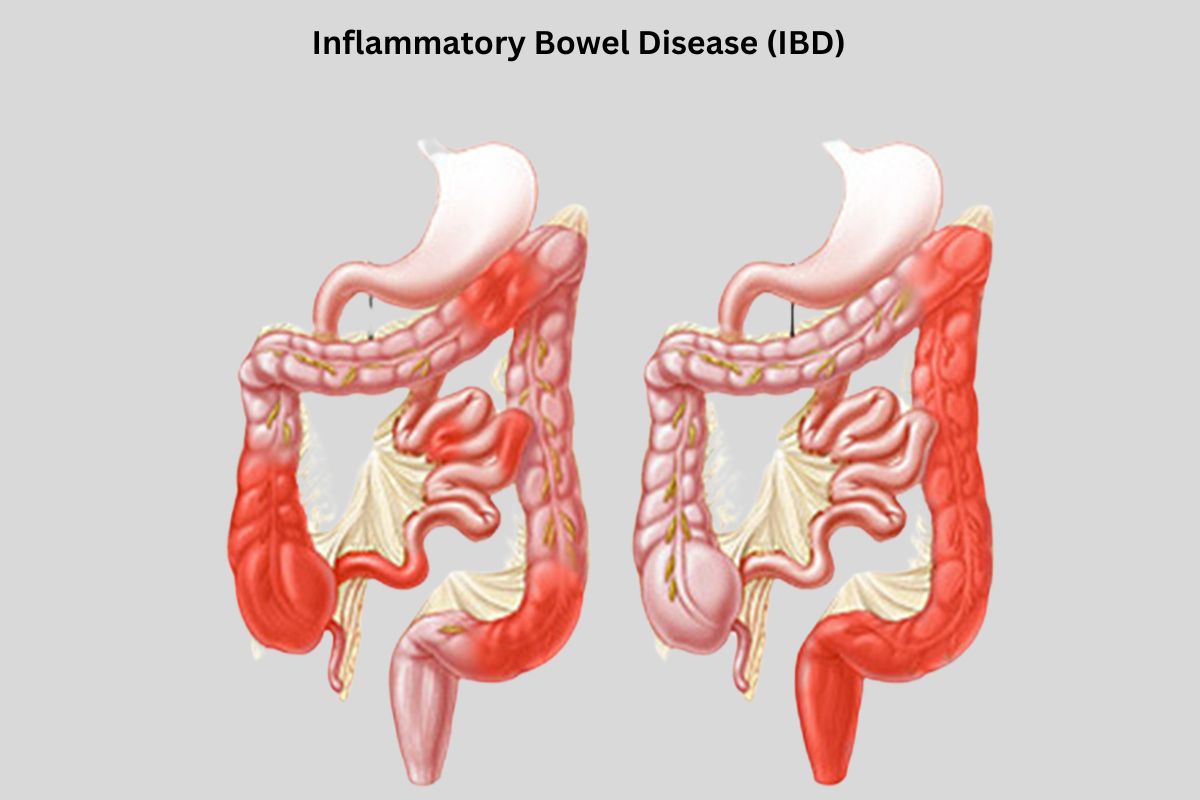 Inflammatory Bowel Disease (IBD)