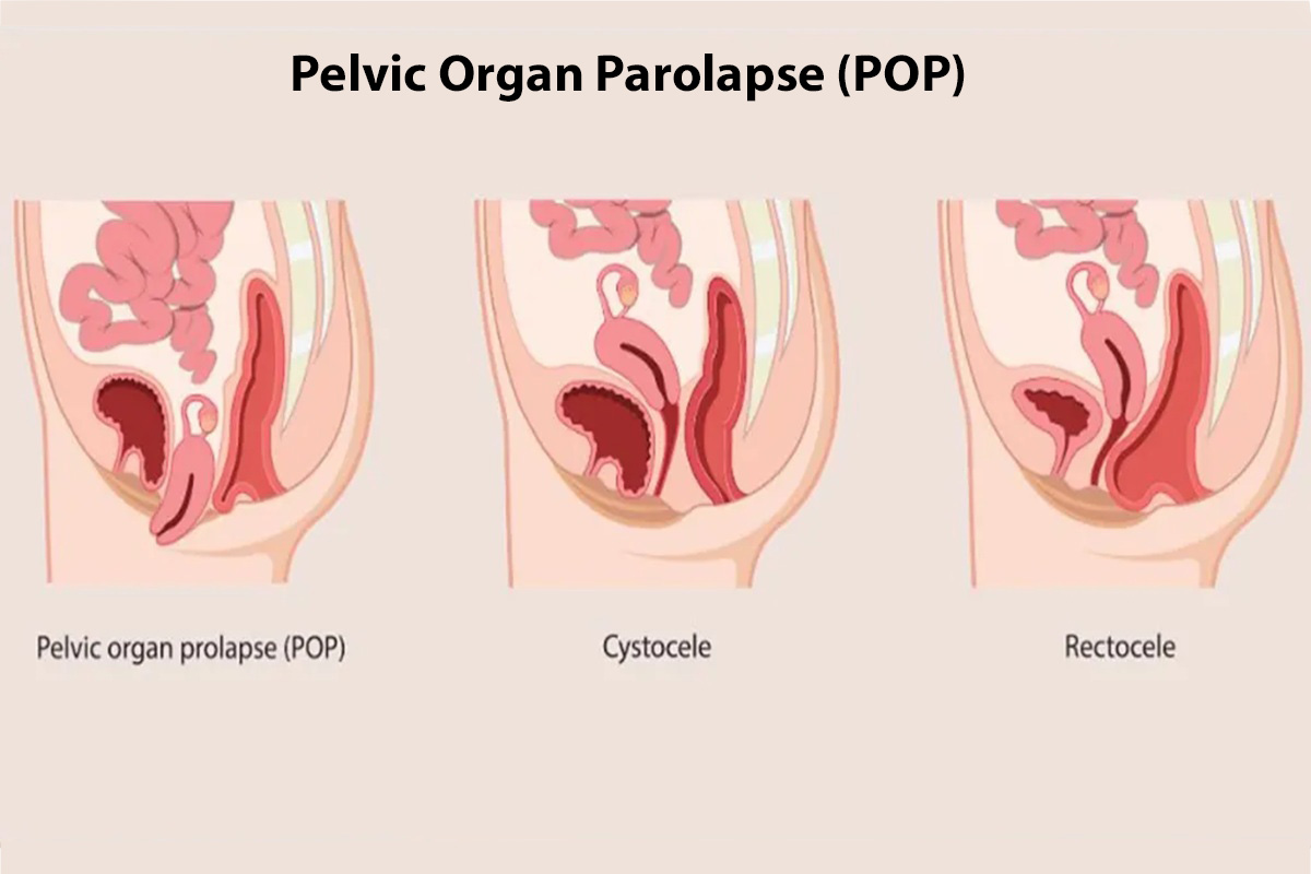 Pelvic Organ Prolapse (POP)